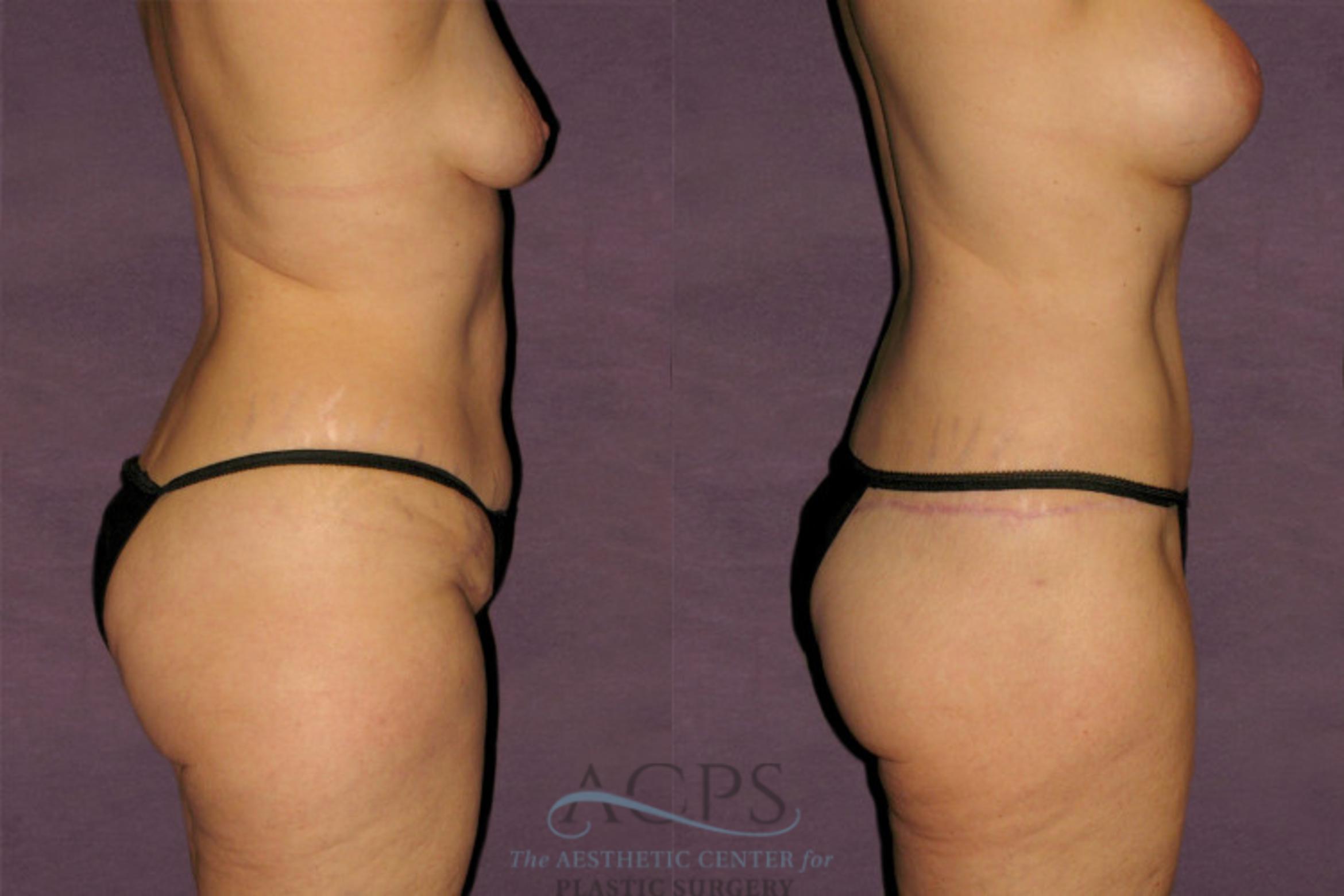 Before & After Tummy Tuck Case 126 Oblique Right View: View in Houston, TX