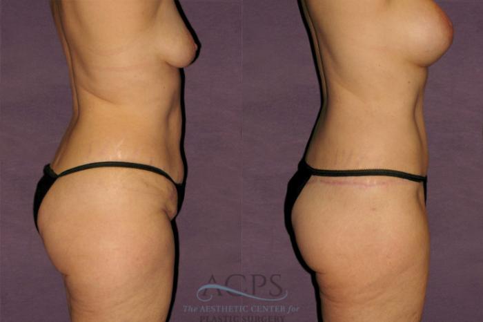 Before & After Tummy Tuck Case 126 Oblique Right View: View in Houston, TX