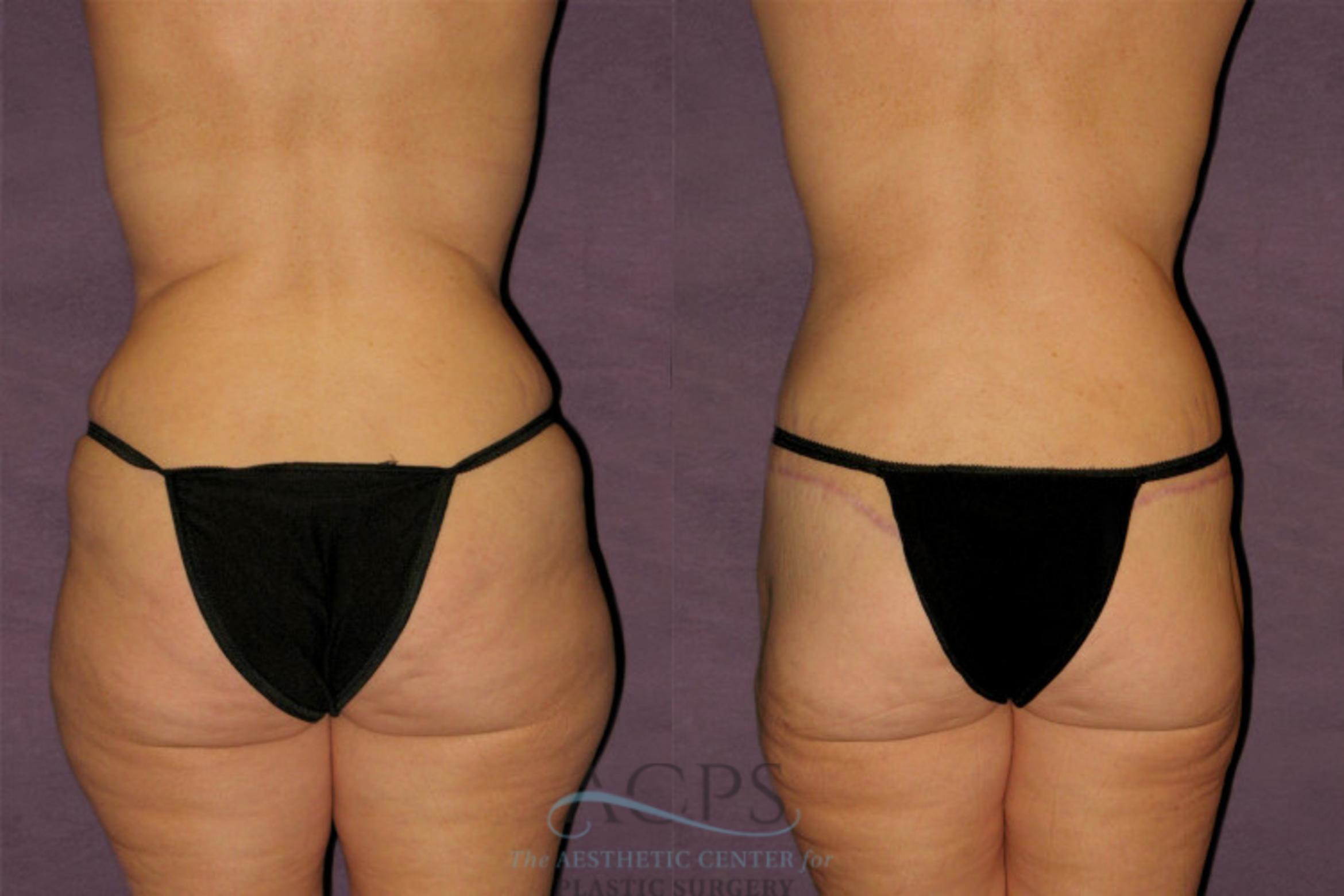 Before & After Tummy Tuck Case 126 Rear View: View in Houston, TX