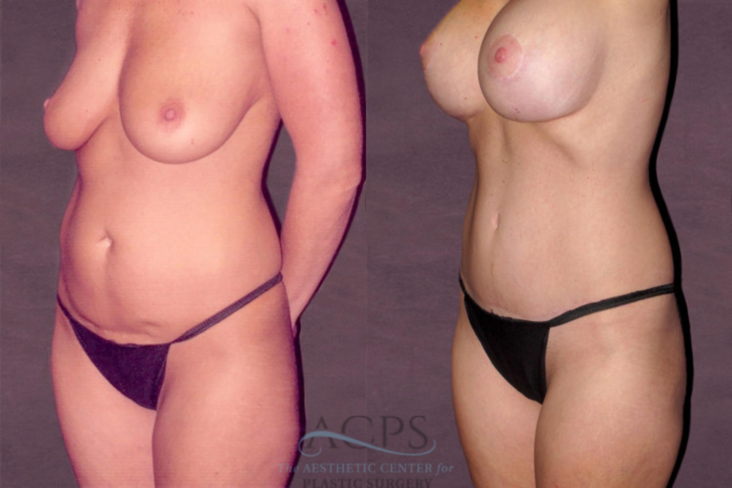 Before & After Tummy Tuck Case 127 Oblique Left View: View in Houston, TX
