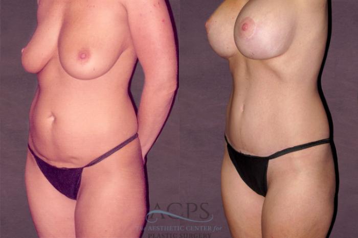 Before & After Tummy Tuck Case 127 Oblique Left View: View in Houston, TX