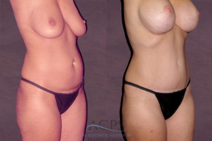 Before & After Tummy Tuck Case 127 Oblique Right View: View in Houston, TX