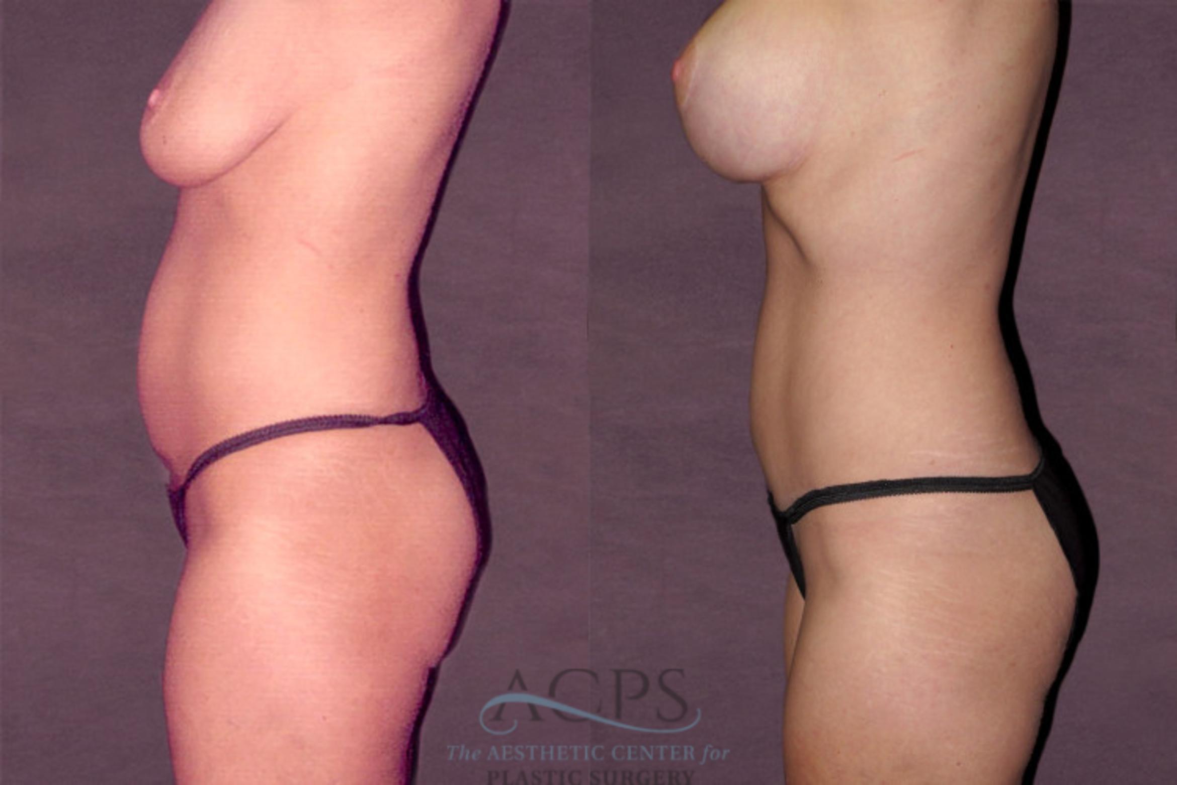 Before & After Tummy Tuck Case 127 Side Left View: View in Houston, TX
