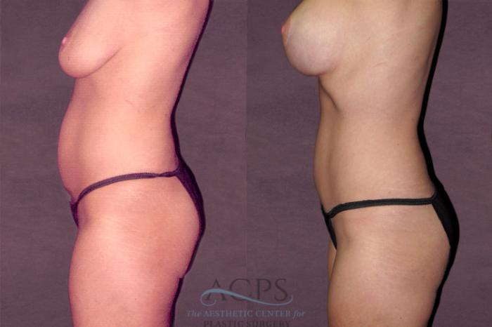 Before & After Tummy Tuck Case 127 Side Left View: View in Houston, TX