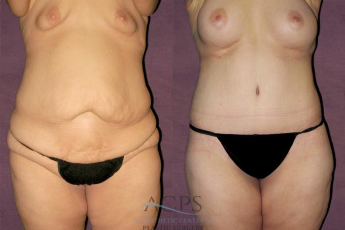 Before & After Liposuction Case 128 Front View: View in Houston, TX