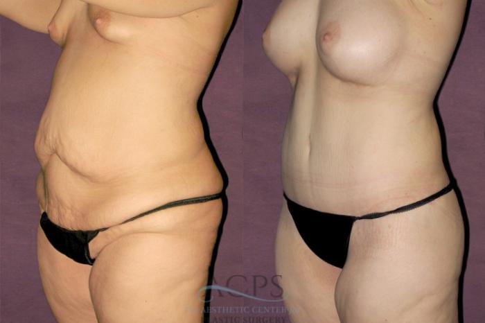 Before & After Liposuction Case 128 Oblique Right View: View in Houston, TX