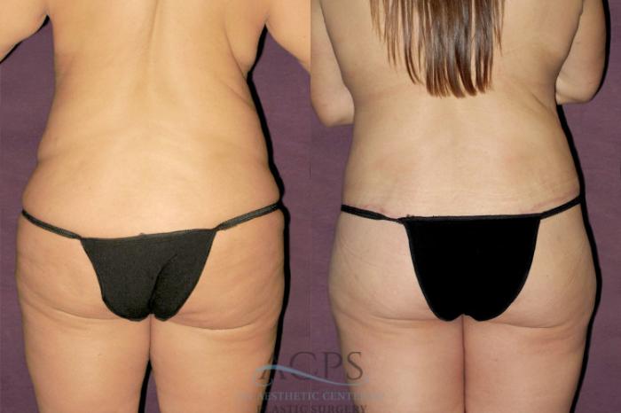 Before & After Liposuction Case 128 Rear View: View in Houston, TX