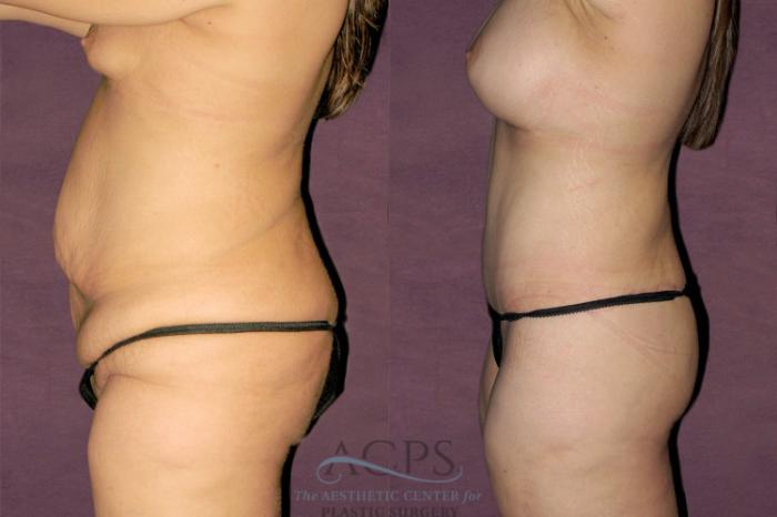 Before & After Liposuction Case 128 Side Left View: View in Houston, TX