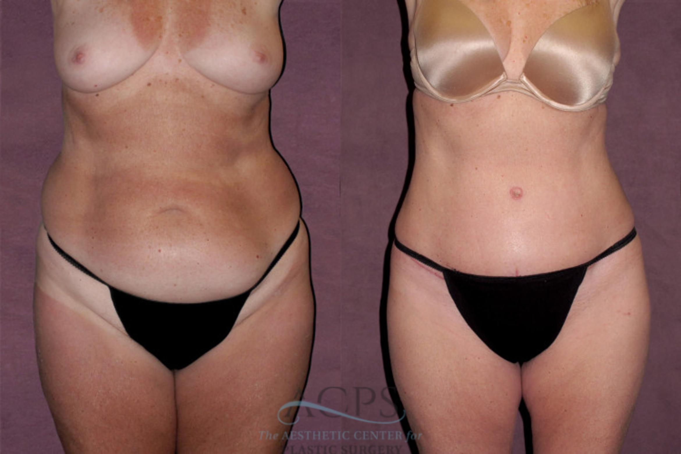 Before & After Tummy Tuck Case 129 Front View: View in Houston, TX