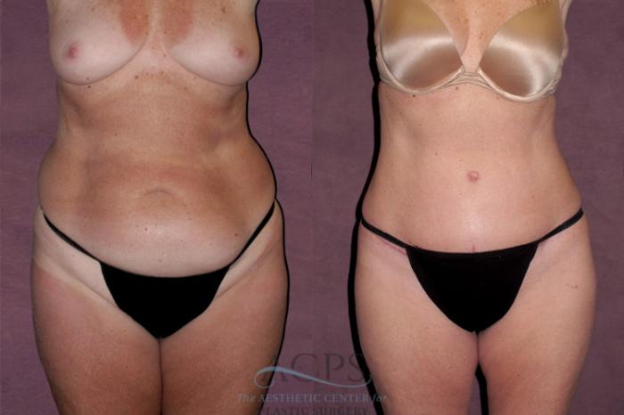 Before & After Tummy Tuck Case 129 Front View: View in Houston, TX