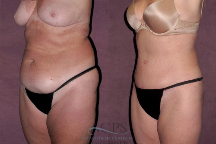Before & After Tummy Tuck Case 129 Oblique Left View: View in Houston, TX
