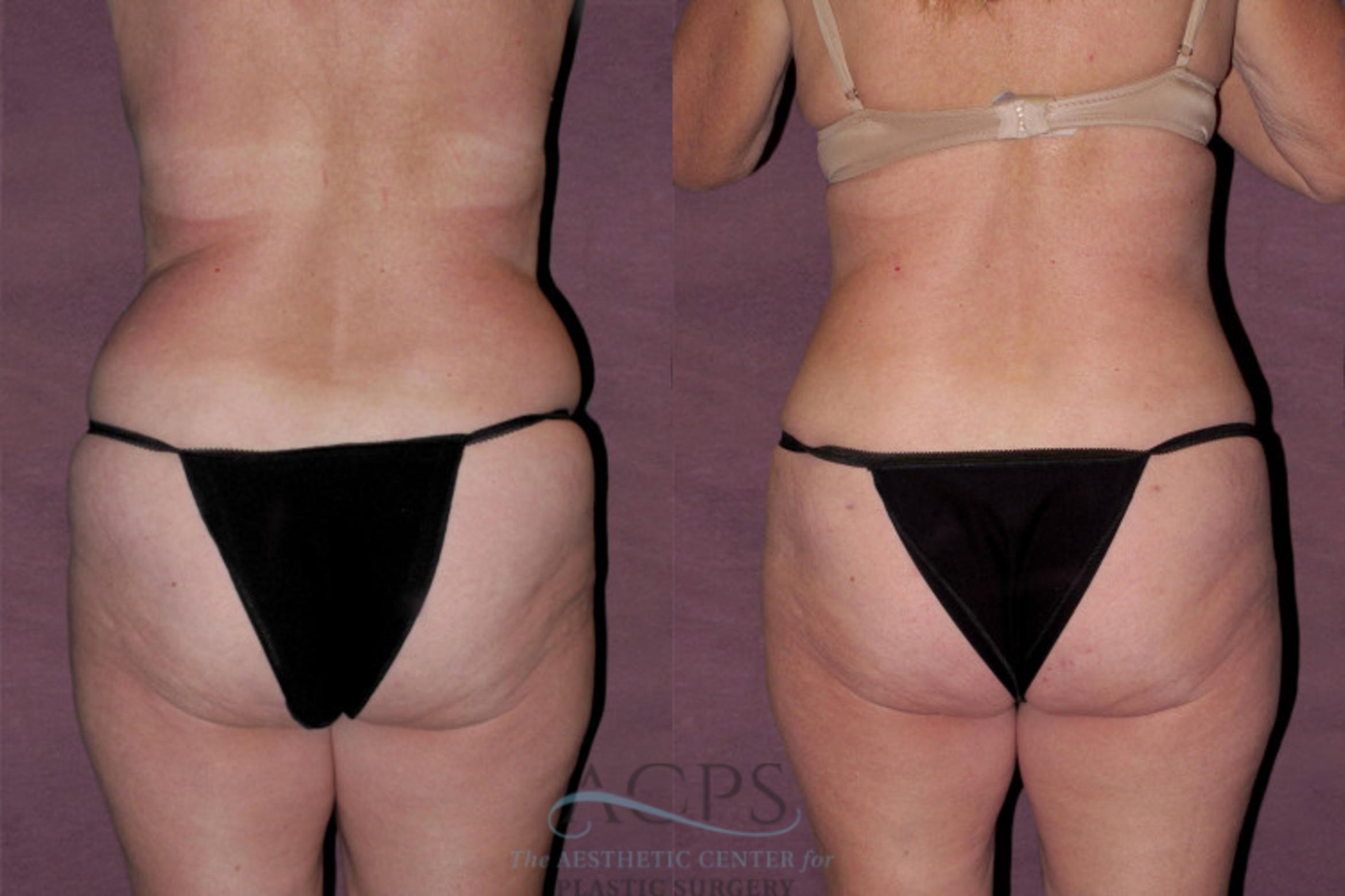 Before & After Tummy Tuck Case 129 Rear View: View in Houston, TX