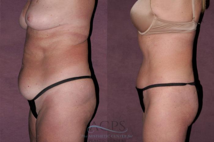 Before & After Tummy Tuck Case 129 Side Left View: View in Houston, TX