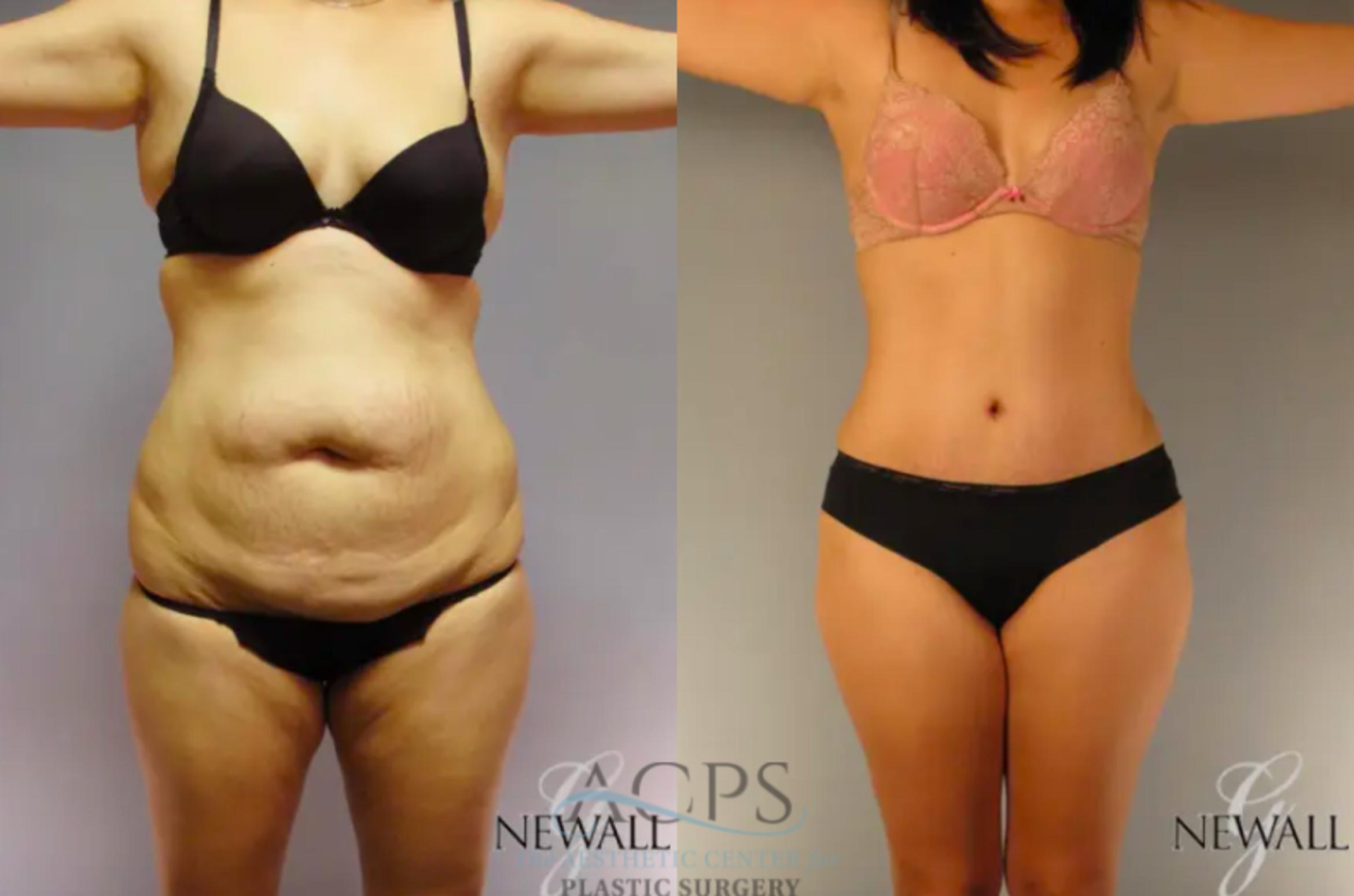 Before & After Tummy Tuck Case 13 Front View: View in Houston, TX