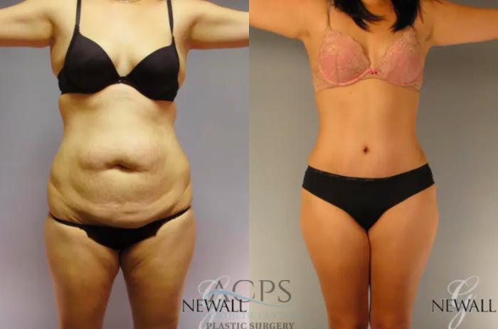 Before & After Tummy Tuck Case 13 Front View: View in Houston, TX