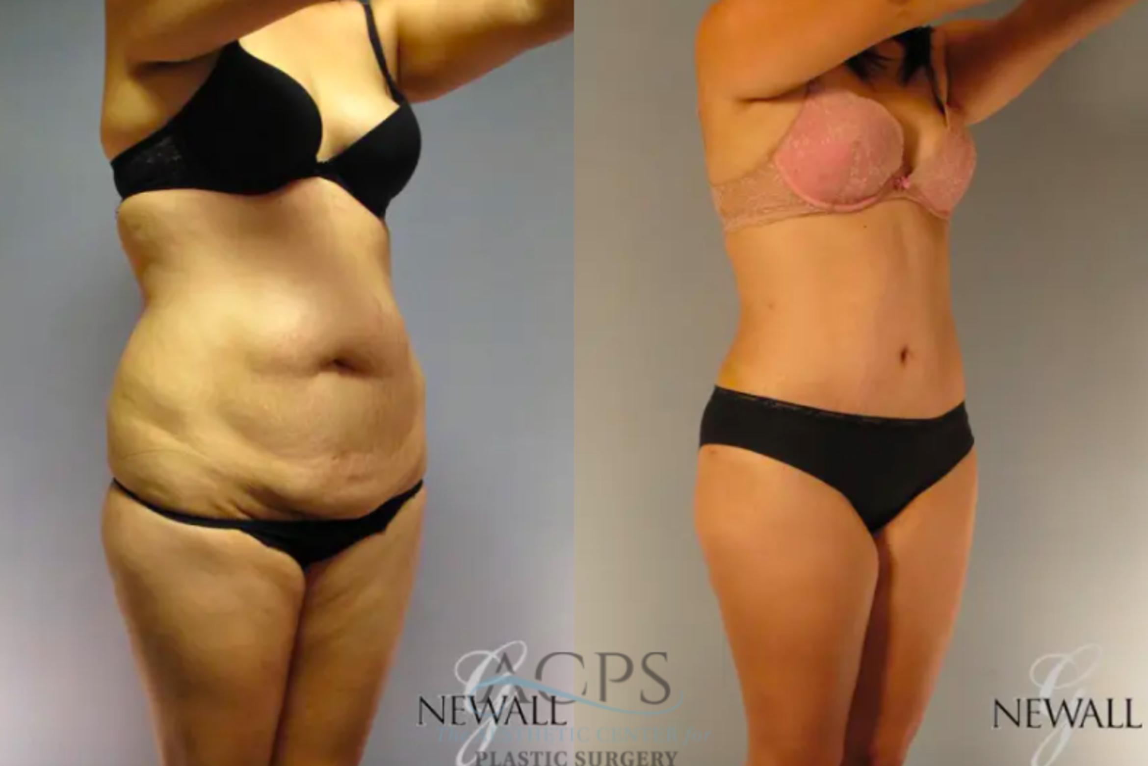 Before & After Tummy Tuck Case 13 Oblique View: View in Houston, TX