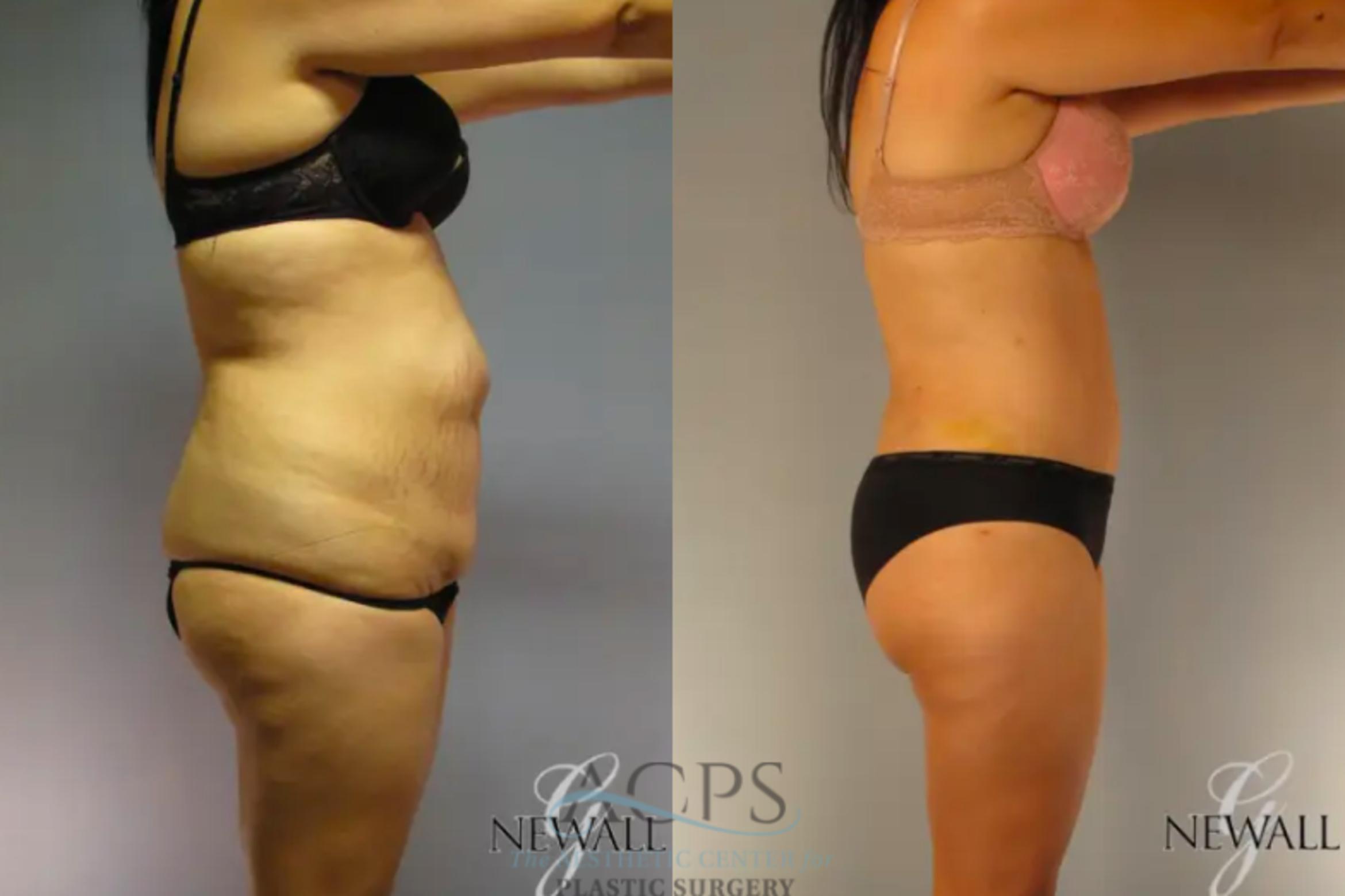 Before & After Tummy Tuck Case 13 Side View: View in Houston, TX