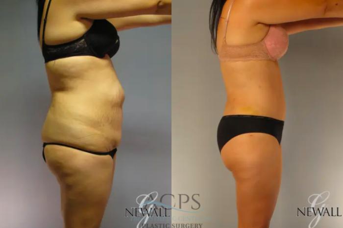 Before & After Tummy Tuck Case 13 Side View: View in Houston, TX