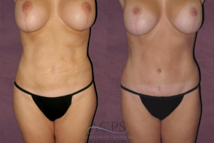 Before & After Tummy Tuck Case 130 Front View: View in Houston, TX