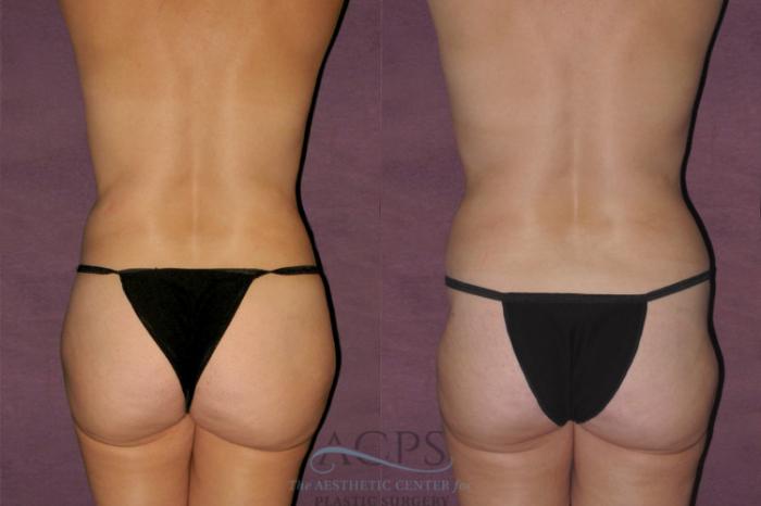 Before & After Tummy Tuck Case 130 Rear View: View in Houston, TX
