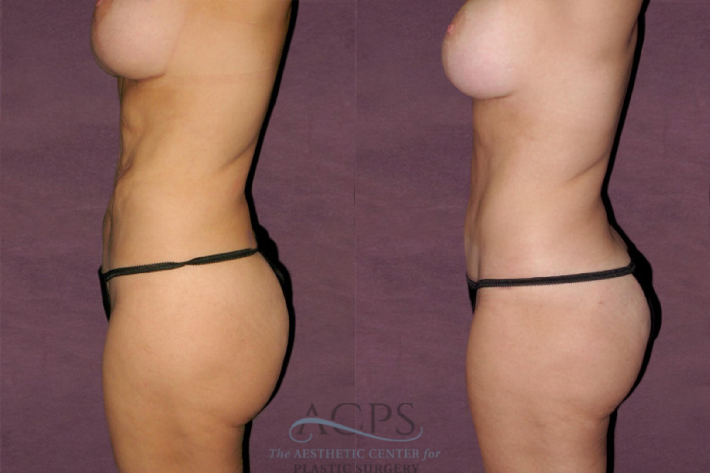 Before & After Tummy Tuck Case 130 Side Left View: View in Houston, TX