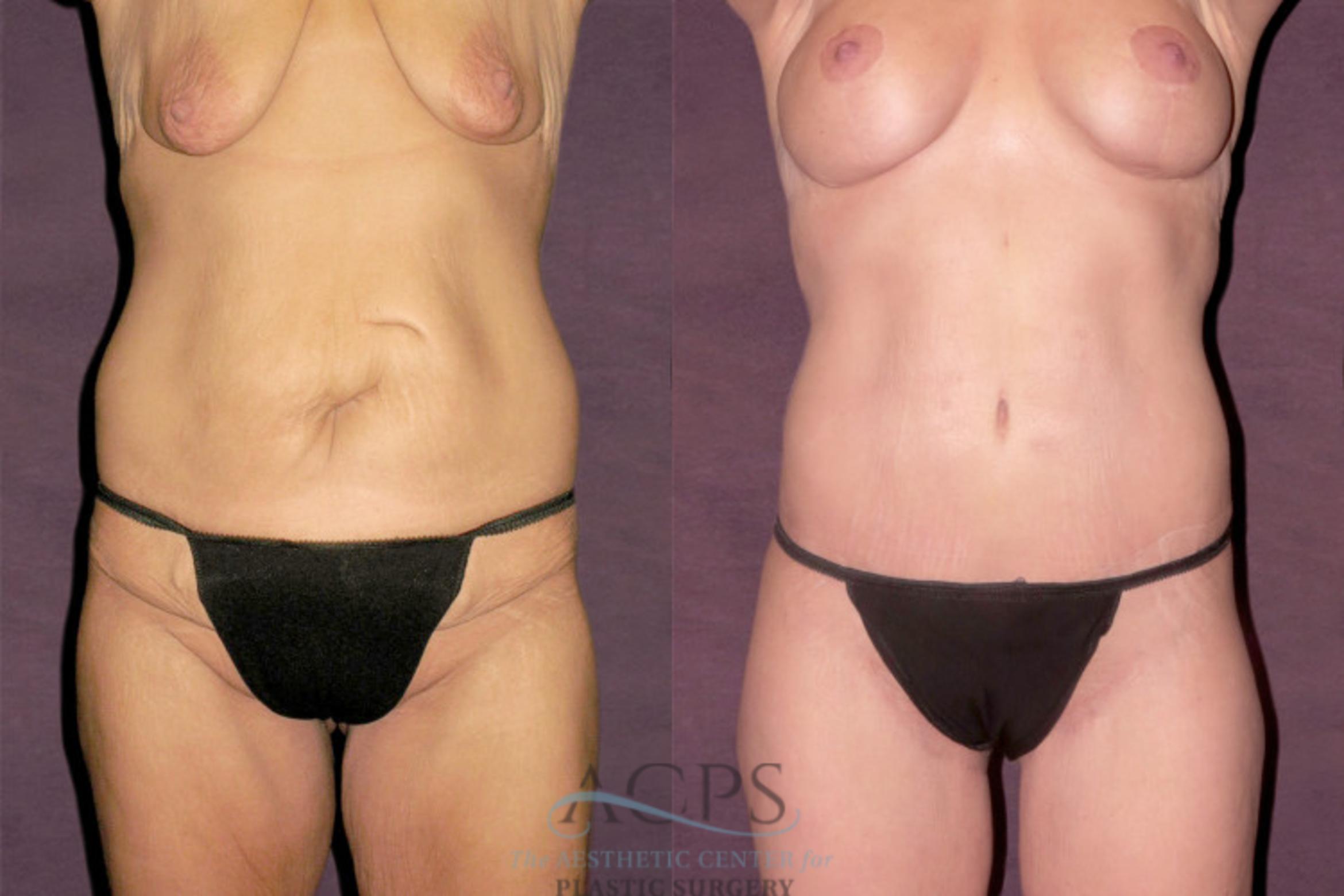 Before & After Liposuction Case 131 Front View: View in Houston, TX