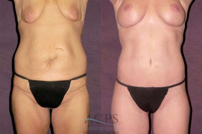 Before & After Liposuction Case 131 Front View: View in Houston, TX
