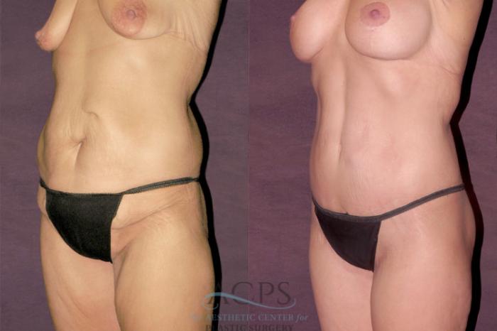 Before & After Liposuction Case 131 Oblique Left View: View in Houston, TX