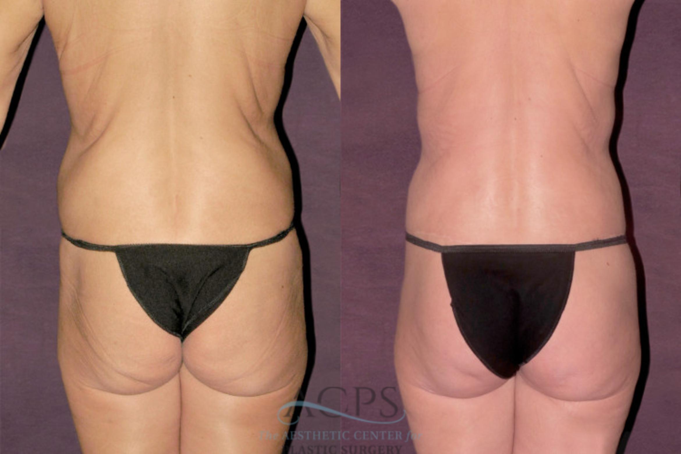 Before & After Liposuction Case 131 Rear View: View in Houston, TX