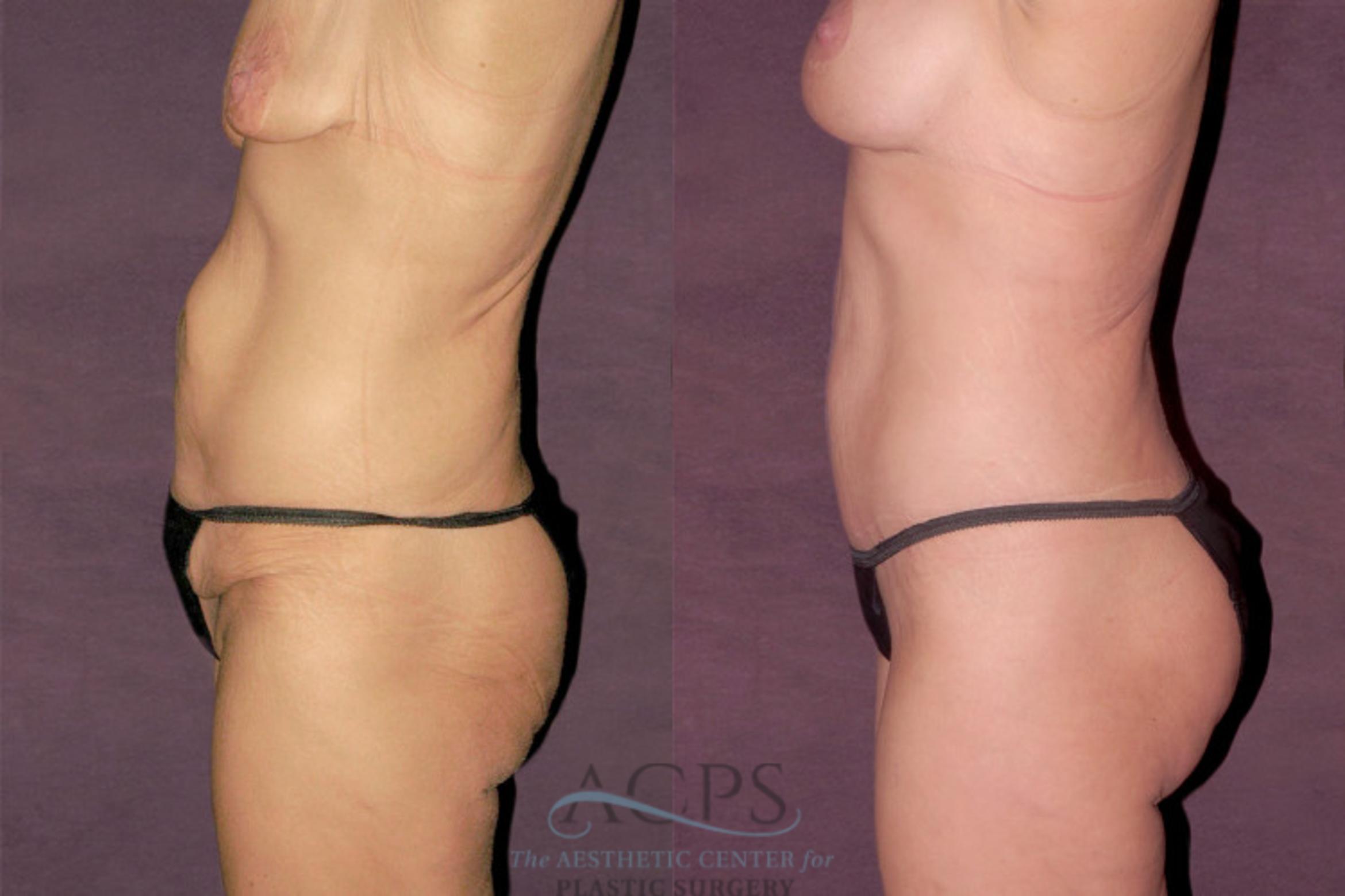 Before & After Liposuction Case 131 Side Left View: View in Houston, TX