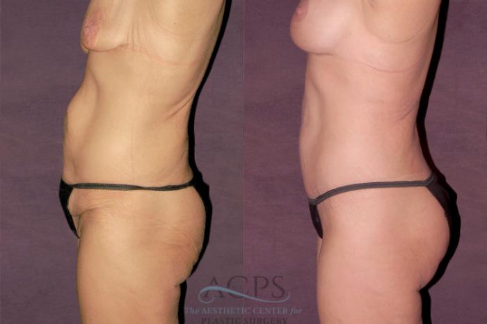 Before & After Liposuction Case 131 Side Left View: View in Houston, TX