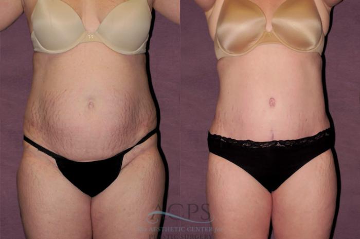 Before & After Tummy Tuck Case 132 Front View: View in Houston, TX