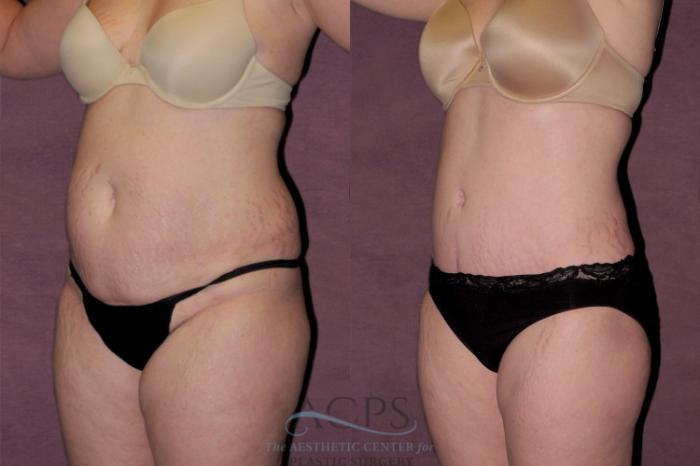 Before & After Tummy Tuck Case 132 Oblique Left View: View in Houston, TX