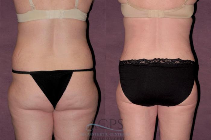 Before & After Tummy Tuck Case 132 Rear View: View in Houston, TX