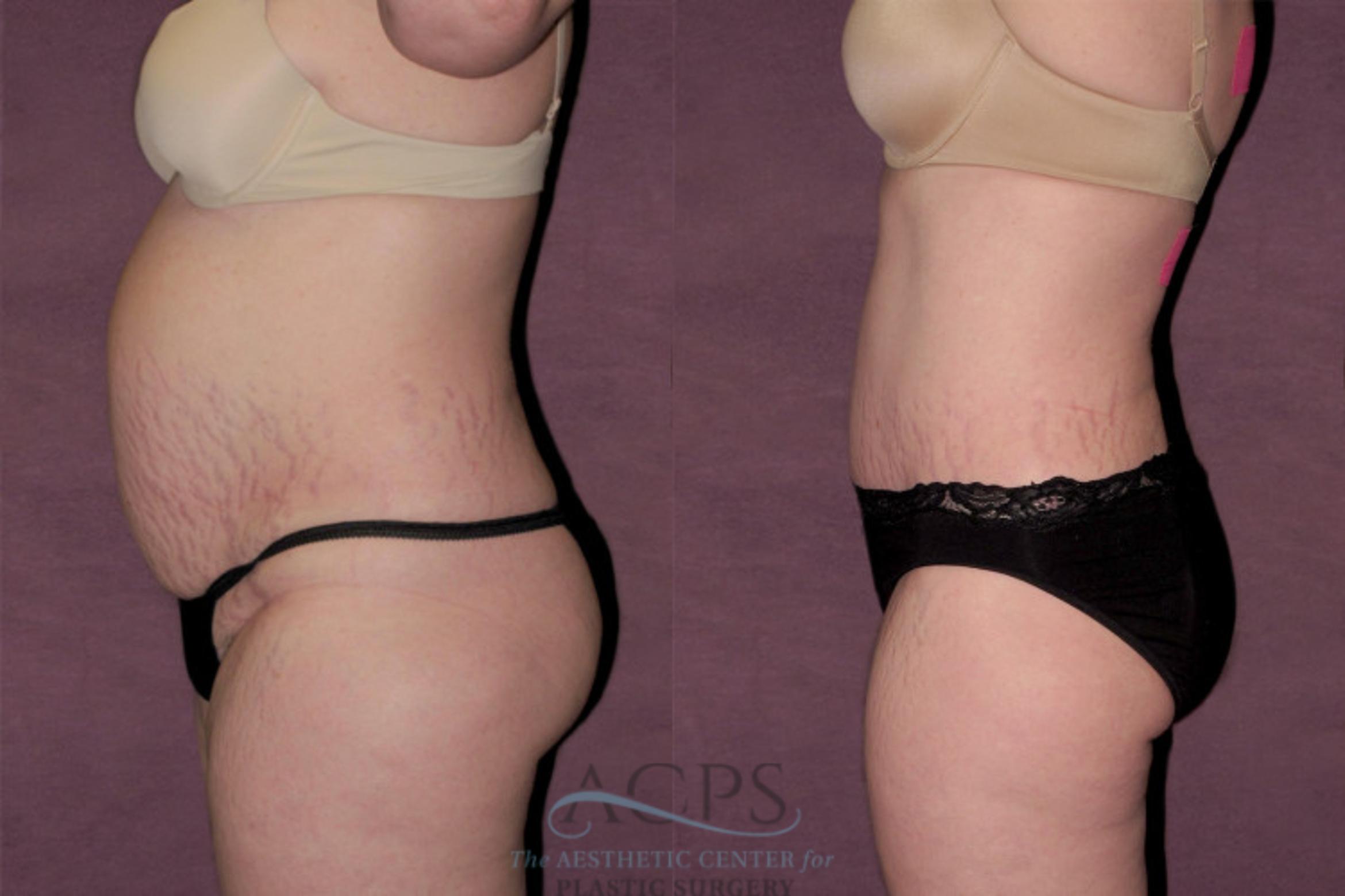 Before & After Tummy Tuck Case 132 Side Left View: View in Houston, TX