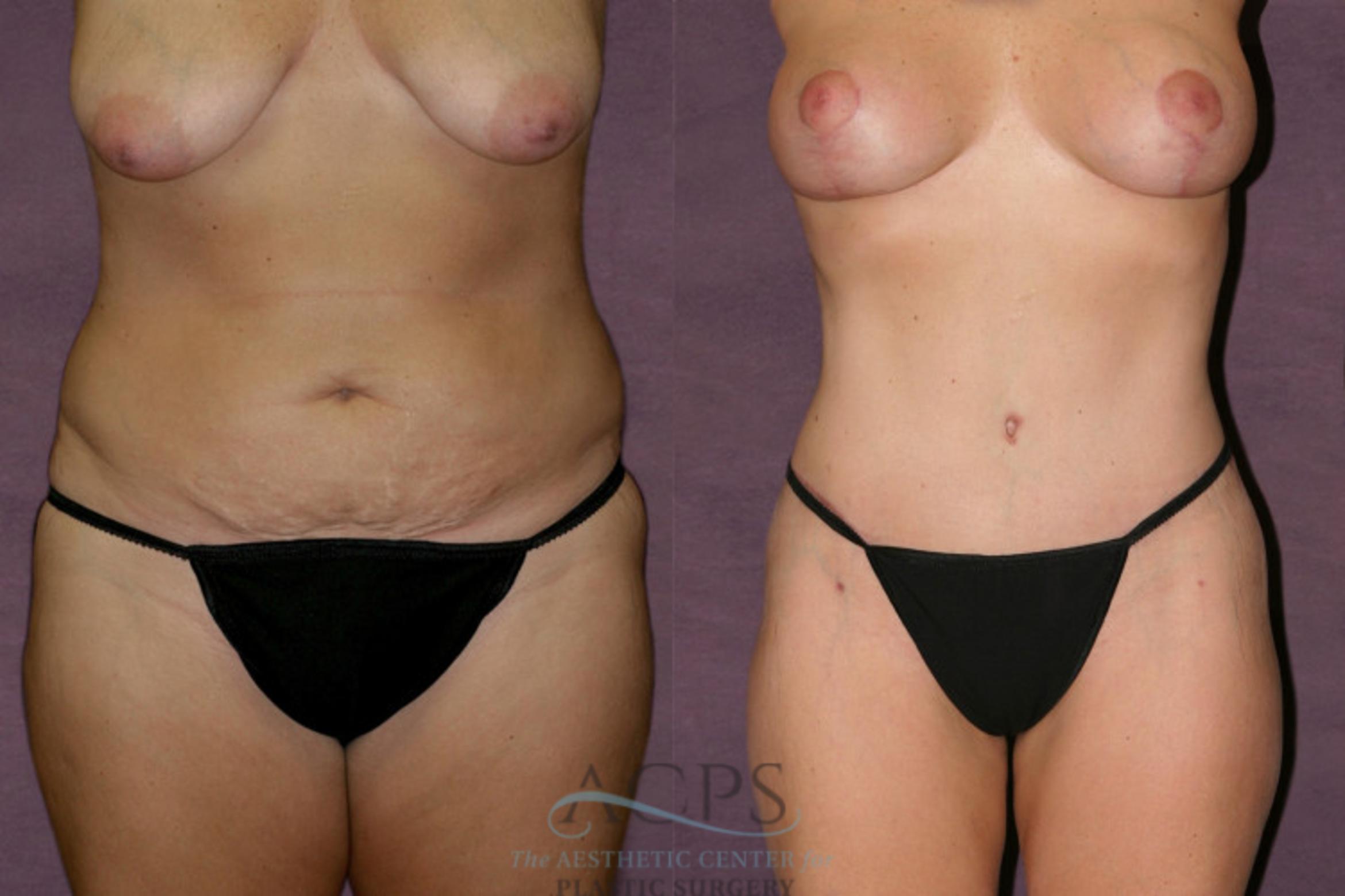 Before & After Liposuction Case 133 Front View: View in Houston, TX