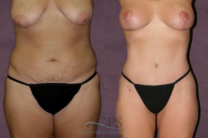 Before & After Liposuction Case 133 Front View: View in Houston, TX