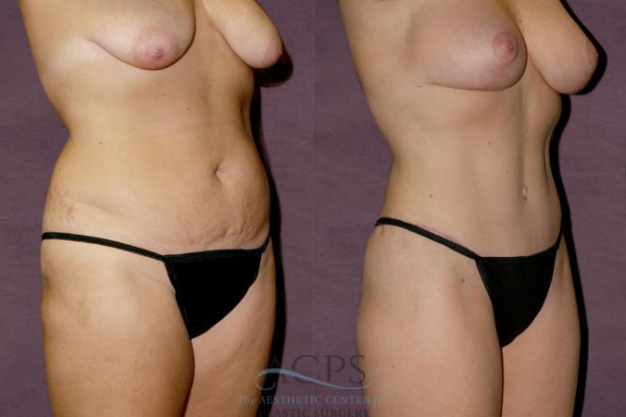 Before & After Liposuction Case 133 Oblique Right View: View in Houston, TX