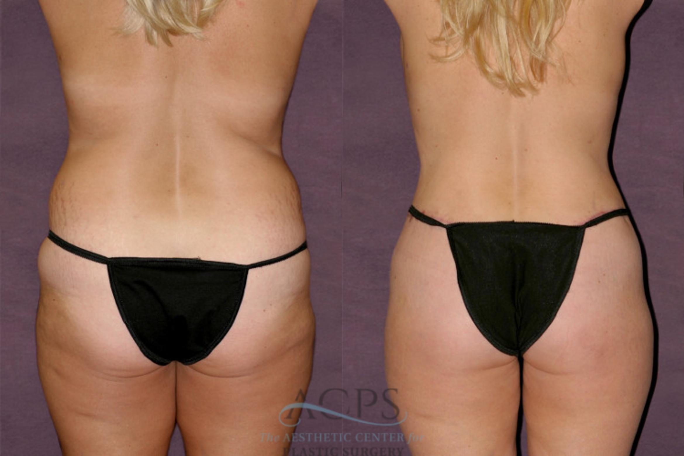 Before & After Liposuction Case 133 Rear View: View in Houston, TX