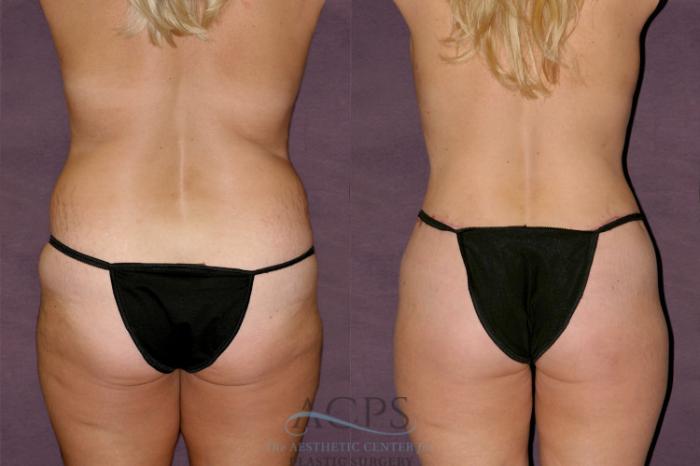 Before & After Liposuction Case 133 Rear View: View in Houston, TX