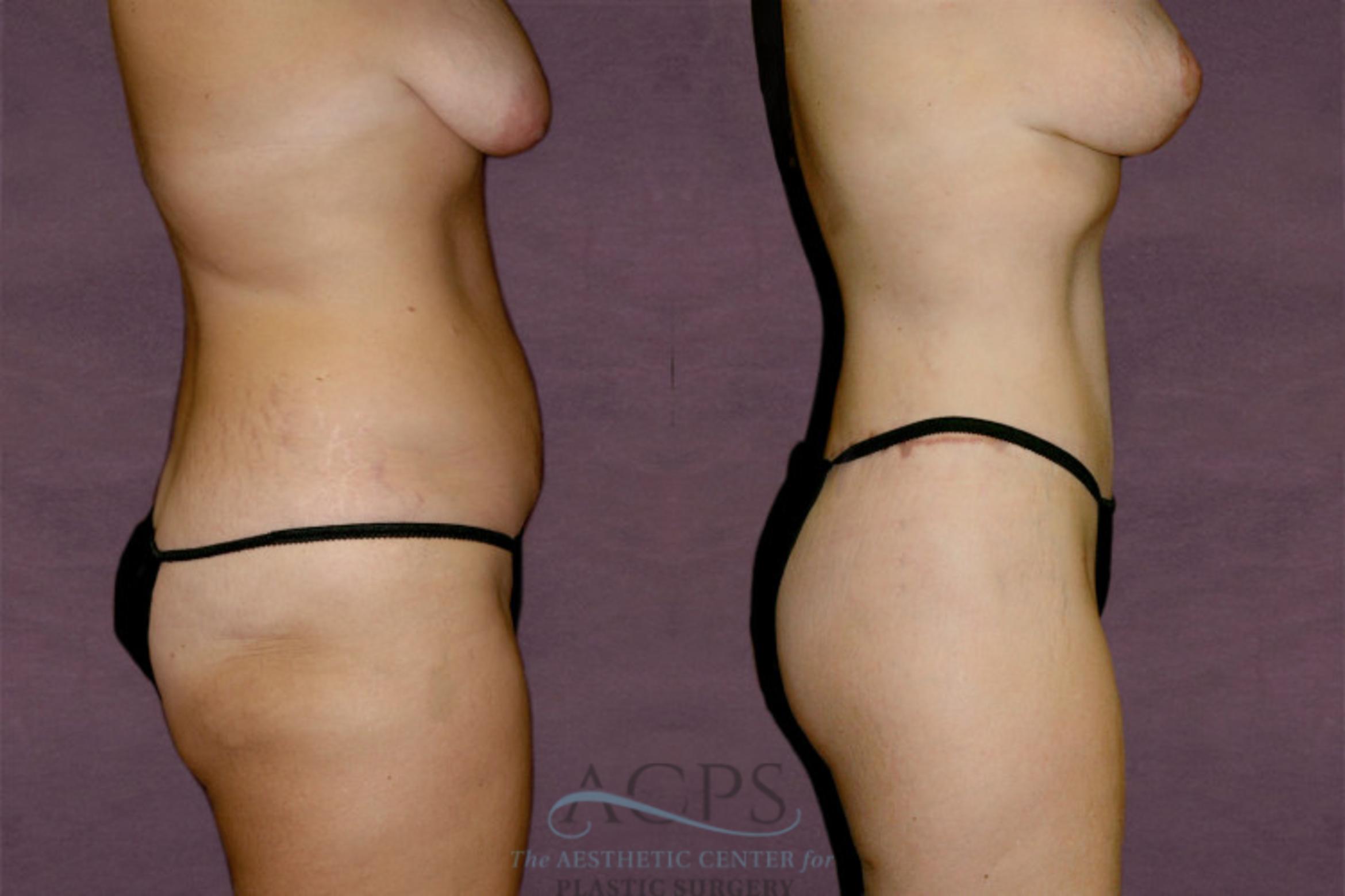 Before & After Liposuction Case 133 Side Right View: View in Houston, TX