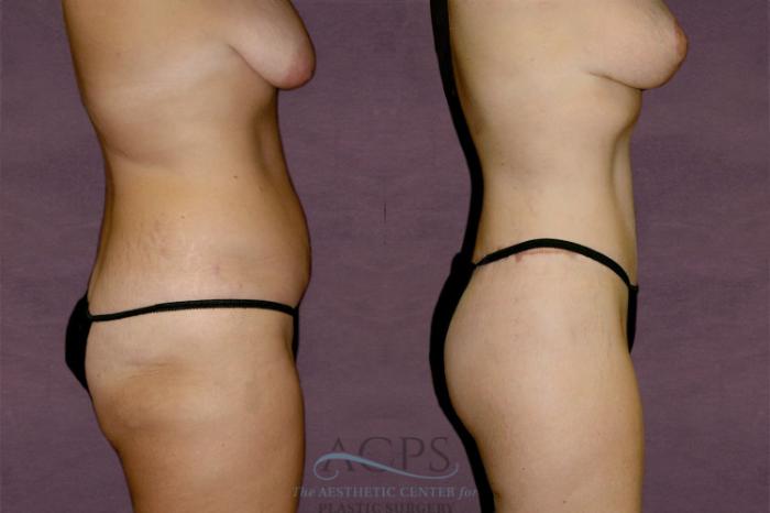 Before & After Liposuction Case 133 Side Right View: View in Houston, TX