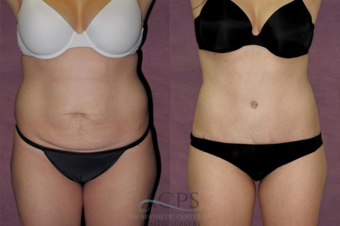 Before & After Tummy Tuck Case 134 Front View: View in Houston, TX
