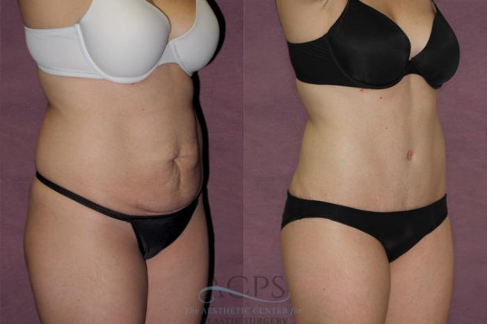 Before & After Tummy Tuck Case 134 Oblique Right View: View in Houston, TX