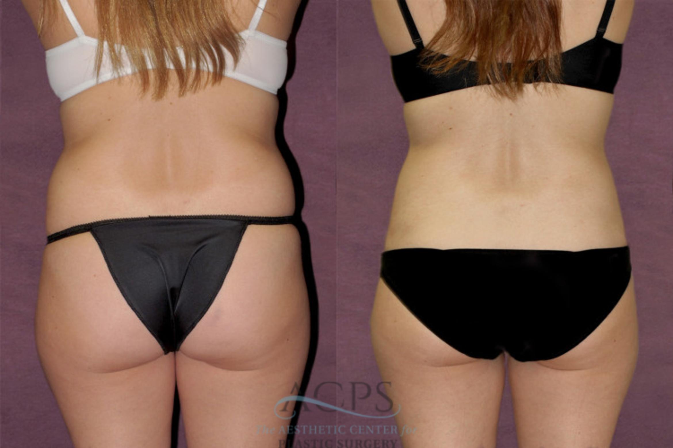 Before & After Tummy Tuck Case 134 Rear View: View in Houston, TX