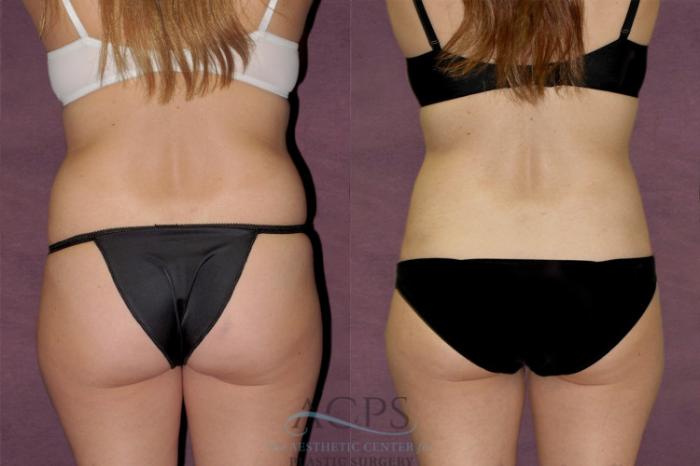 Before & After Tummy Tuck Case 134 Rear View: View in Houston, TX
