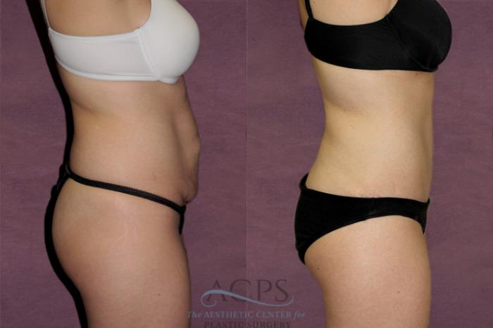 Before & After Tummy Tuck Case 134 Side Right View: View in Houston, TX