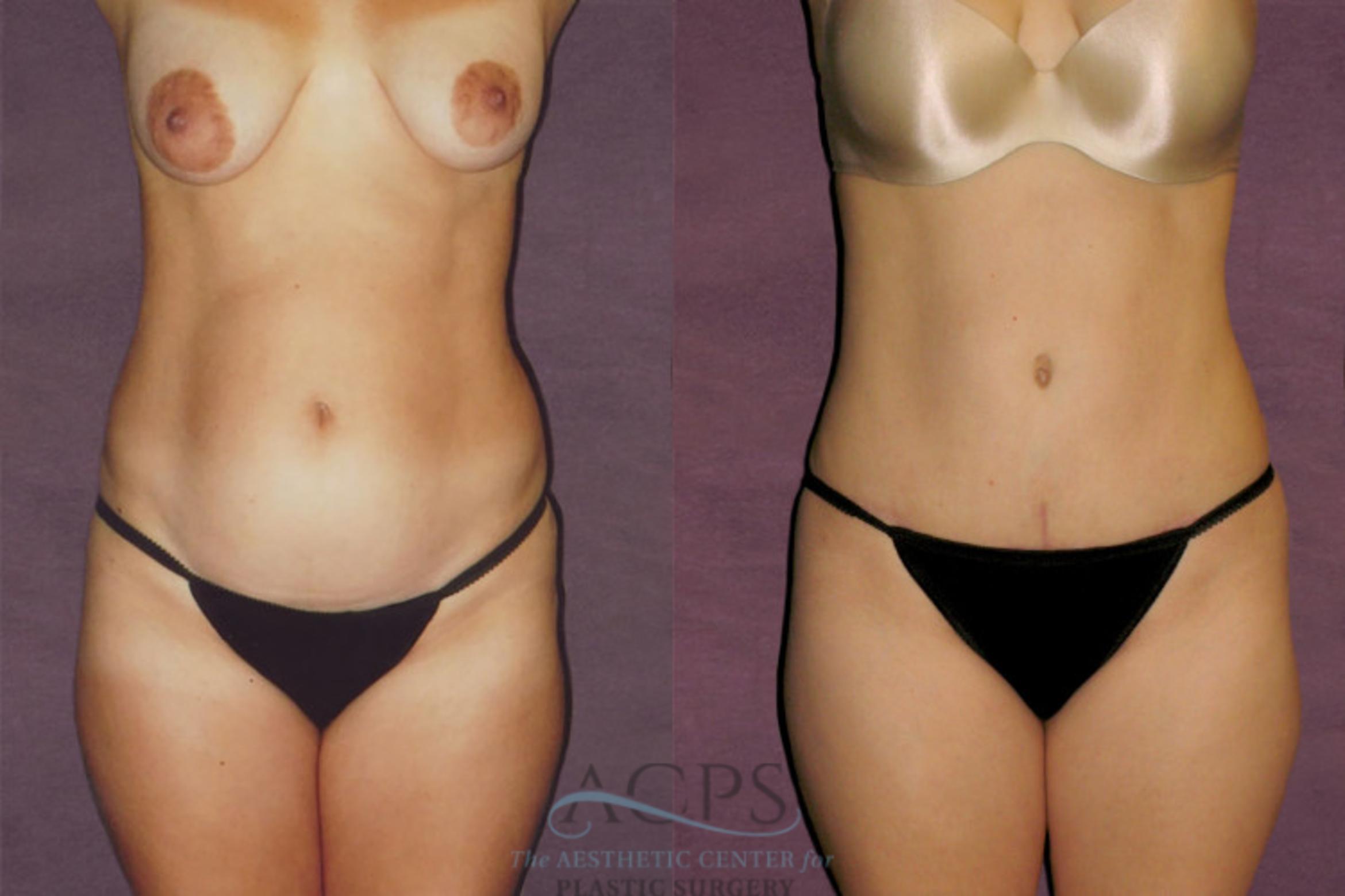 Before & After Liposuction Case 135 Front View: View in Houston, TX
