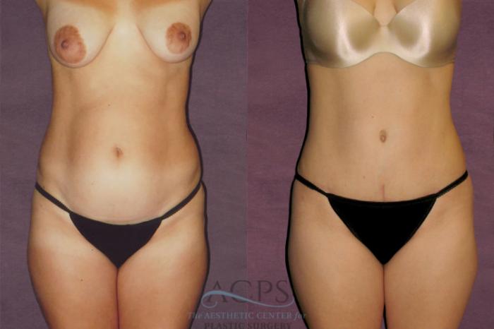 Before & After Liposuction Case 135 Front View: View in Houston, TX