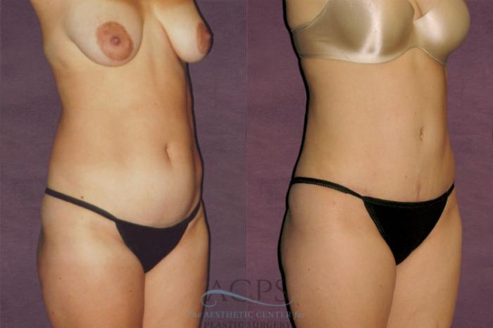 Before & After Liposuction Case 135 Oblique Right View: View in Houston, TX
